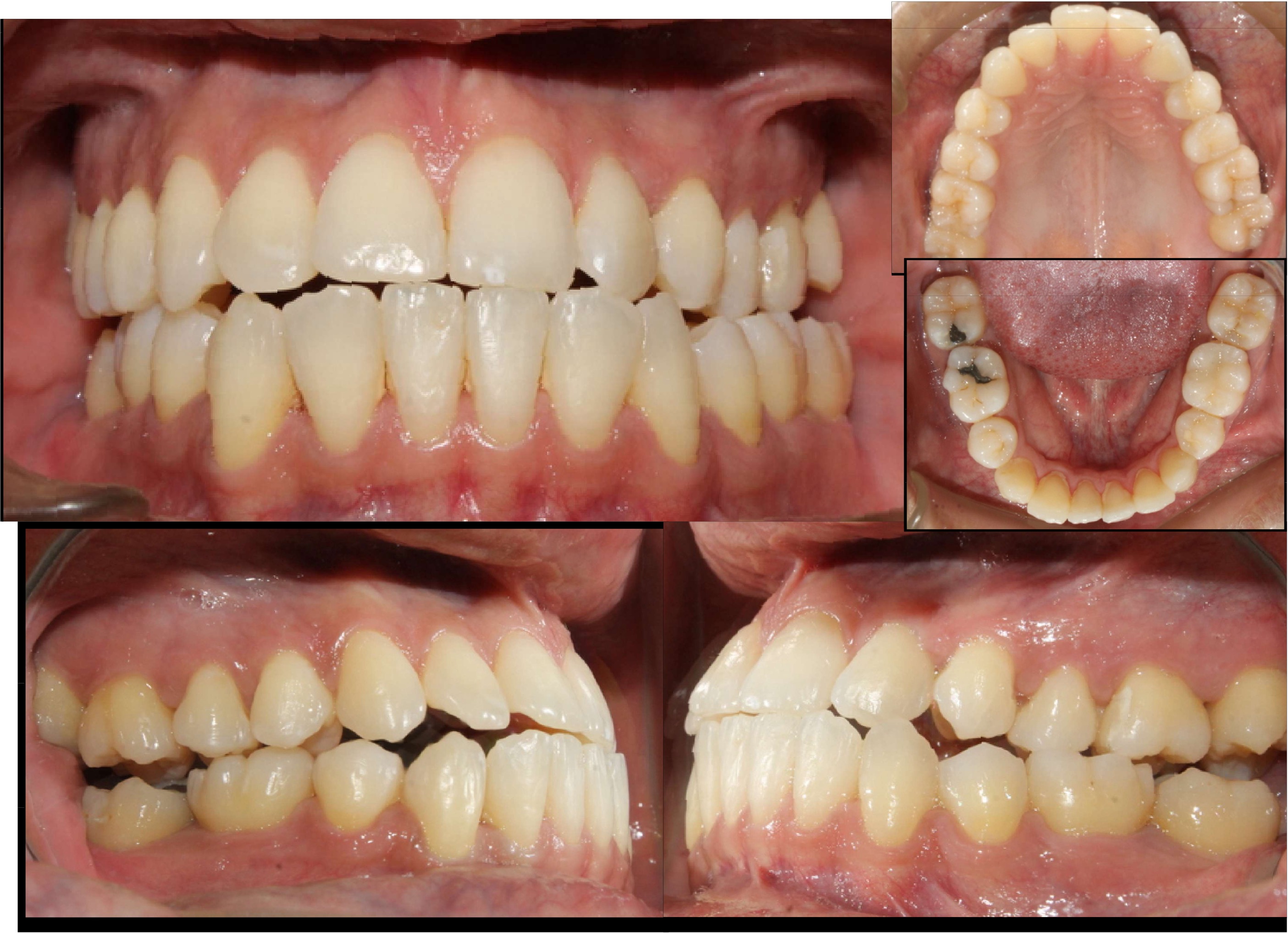 Antes del tratamiento ortodóncico