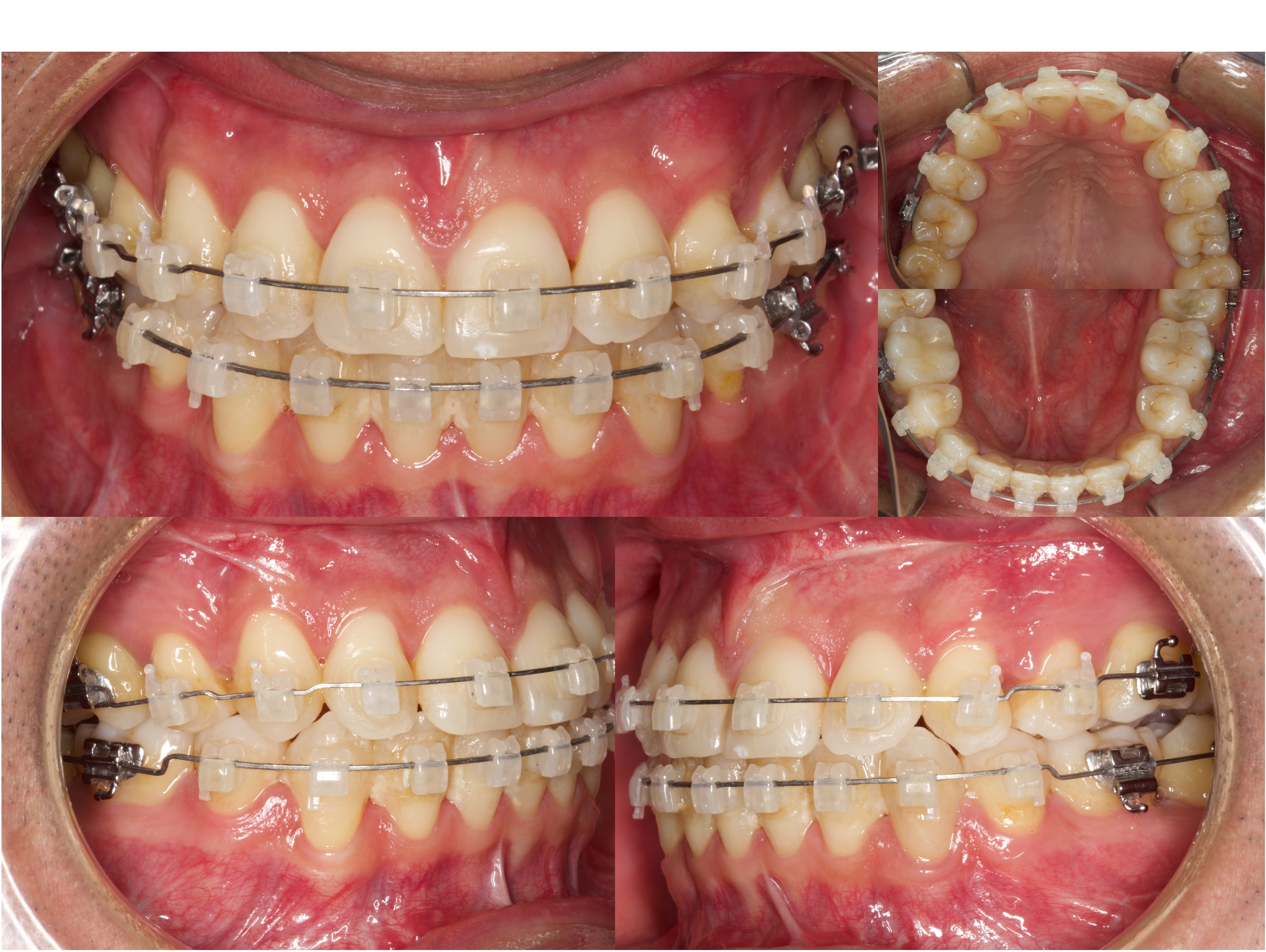Después del tratamiento ortodóncico