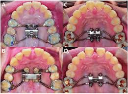 MARPE - Expansión maxilar